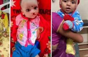 श्रवण बाधित बच्चों के लिए खुशखबरी, योगी सरकार ने निशुल्क ऑपरेशन के लिए मांगे आवेदन